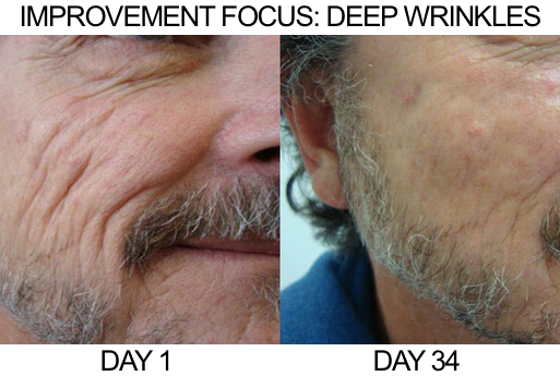 man_deep_wrinkles_example
