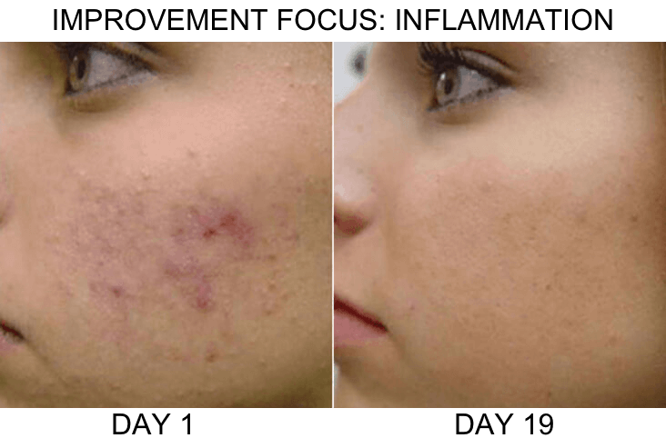 acne_example1-2